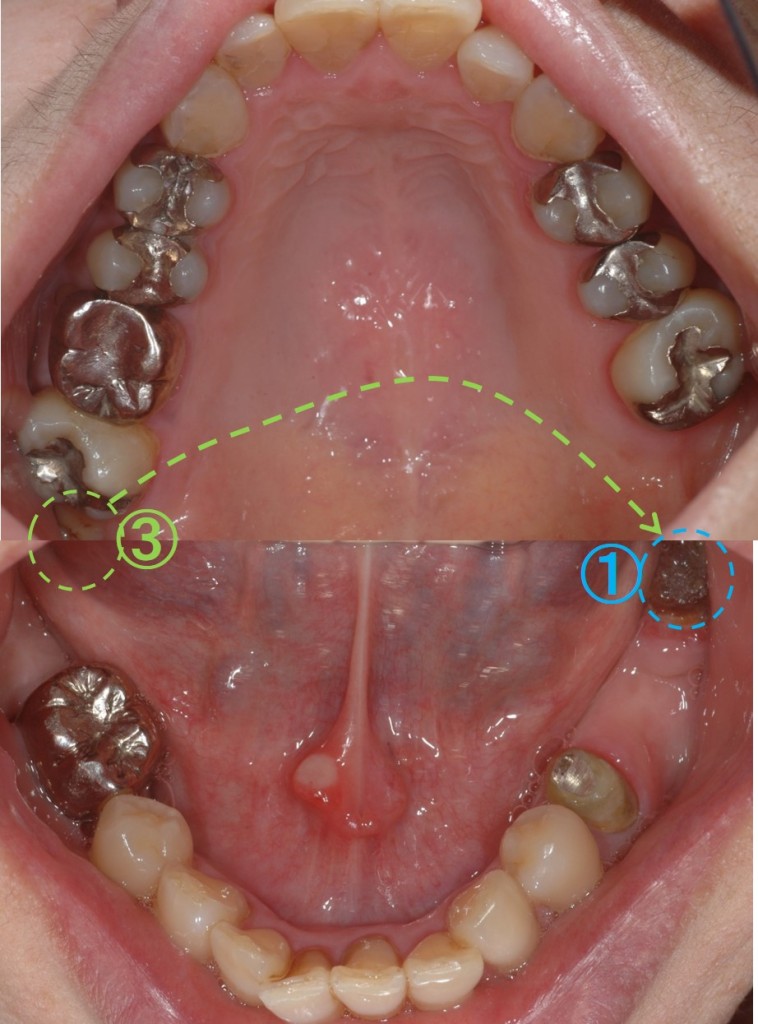 歯の移植（歯周病）１