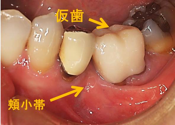 115 歯周病を増悪する頬小帯 渡辺歯科医院blog 渡辺歯科医院