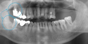 歯の移植（歯周病ケース）