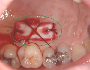 テルダーミス移植
