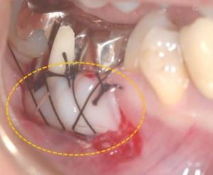 遊離歯肉移植術