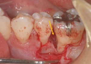 歯周病手術