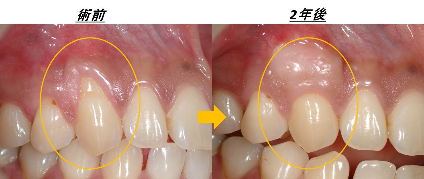 根面被覆術前・術後