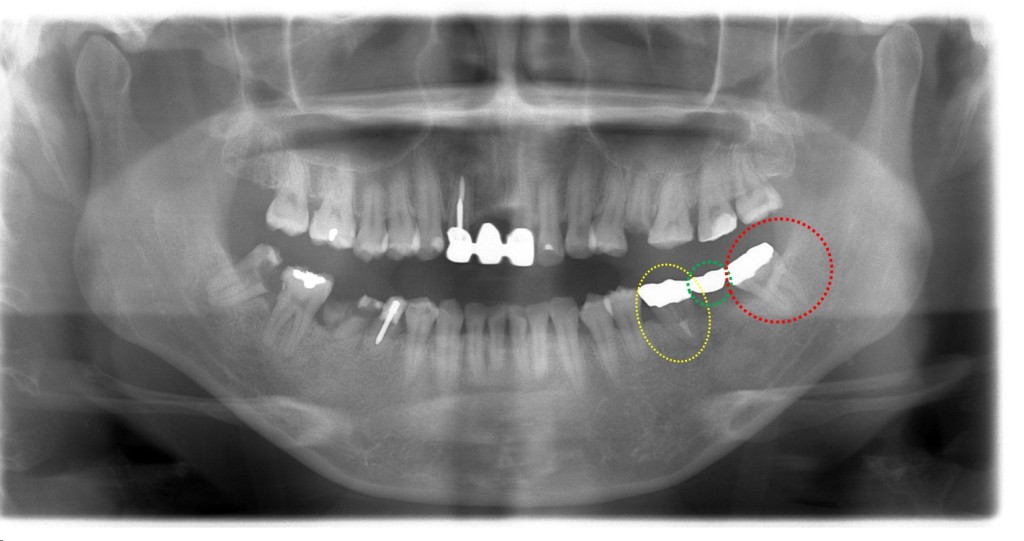 親知らずの移植１　歯周病専門医　渡辺歯科医院（小矢部市砺波地区）
