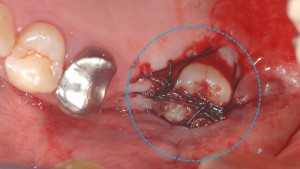 歯の移植（歯周病ケース）