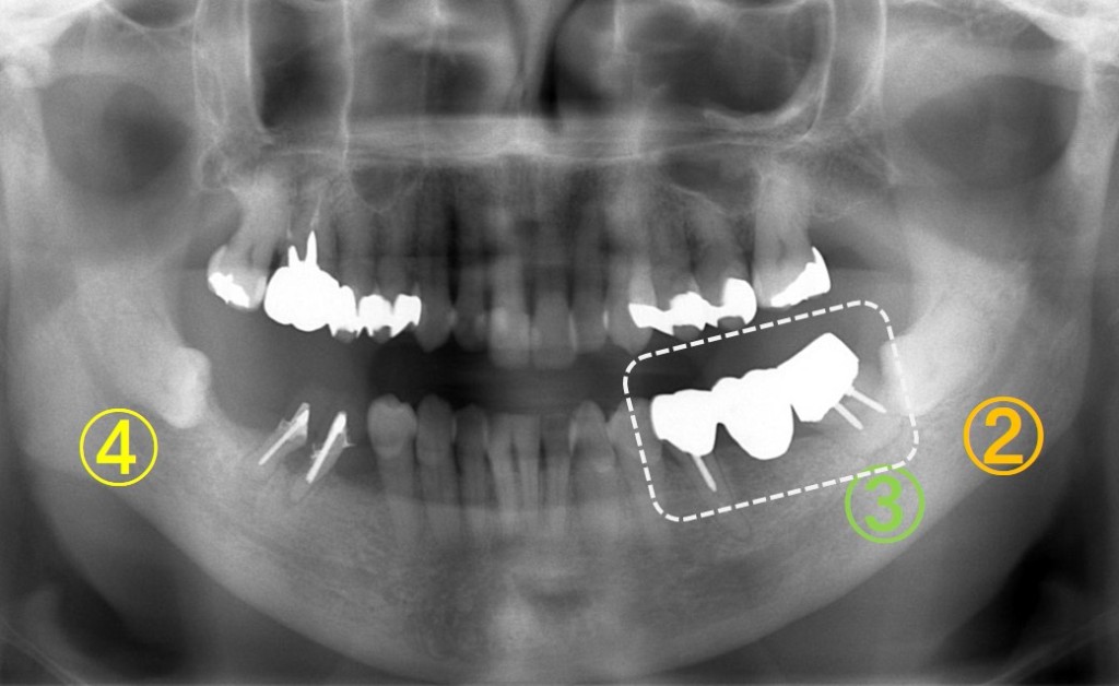 歯の移植（歯周病）４