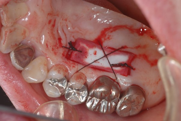 歯肉移植（口蓋）