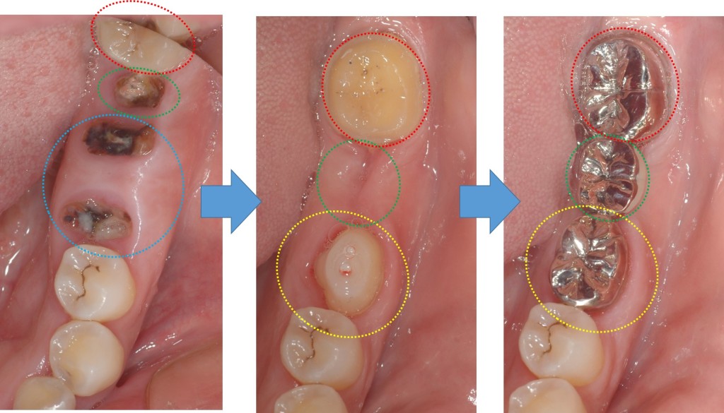 親知らずの移植4　歯周病専門医　渡辺歯科医院（小矢部市砺波地区）