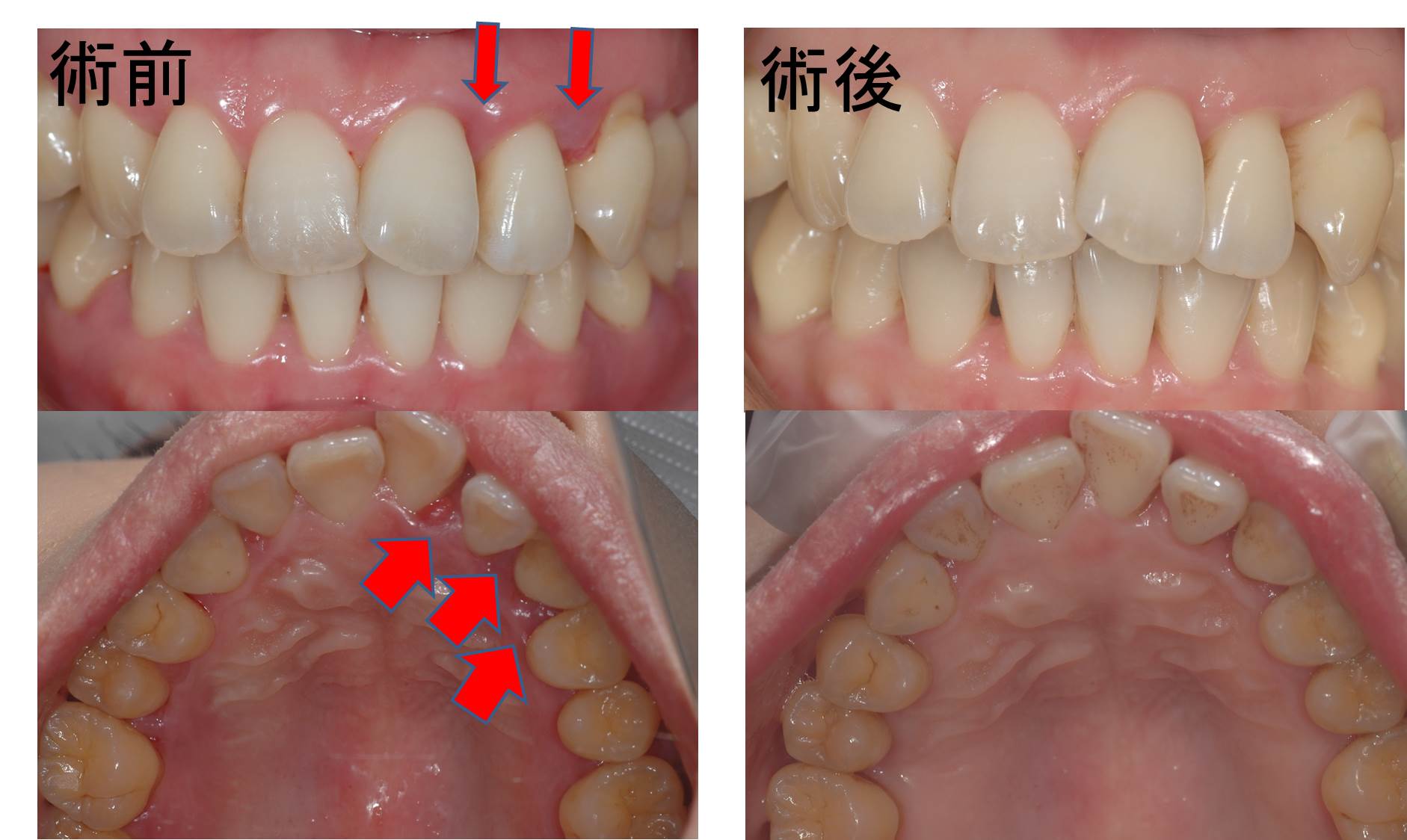 108.歯周病治療で起こった変化：渡辺歯科医院Blog - 渡辺歯科医院