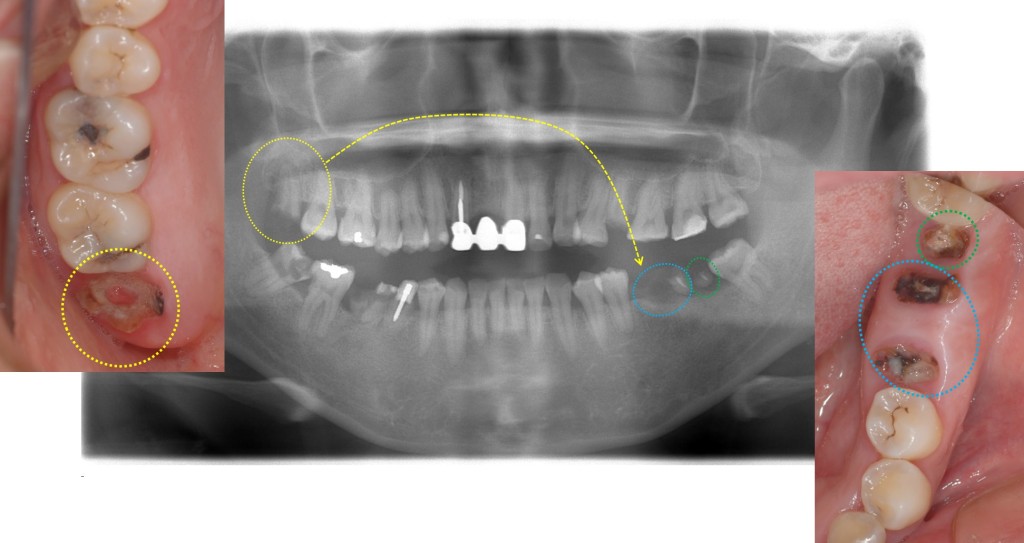 親知らずの移植１　歯周病専門医　渡辺歯科医院（小矢部市砺波地区）