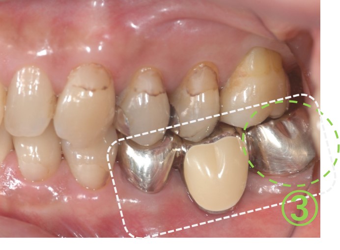 歯の移植（歯周病）７