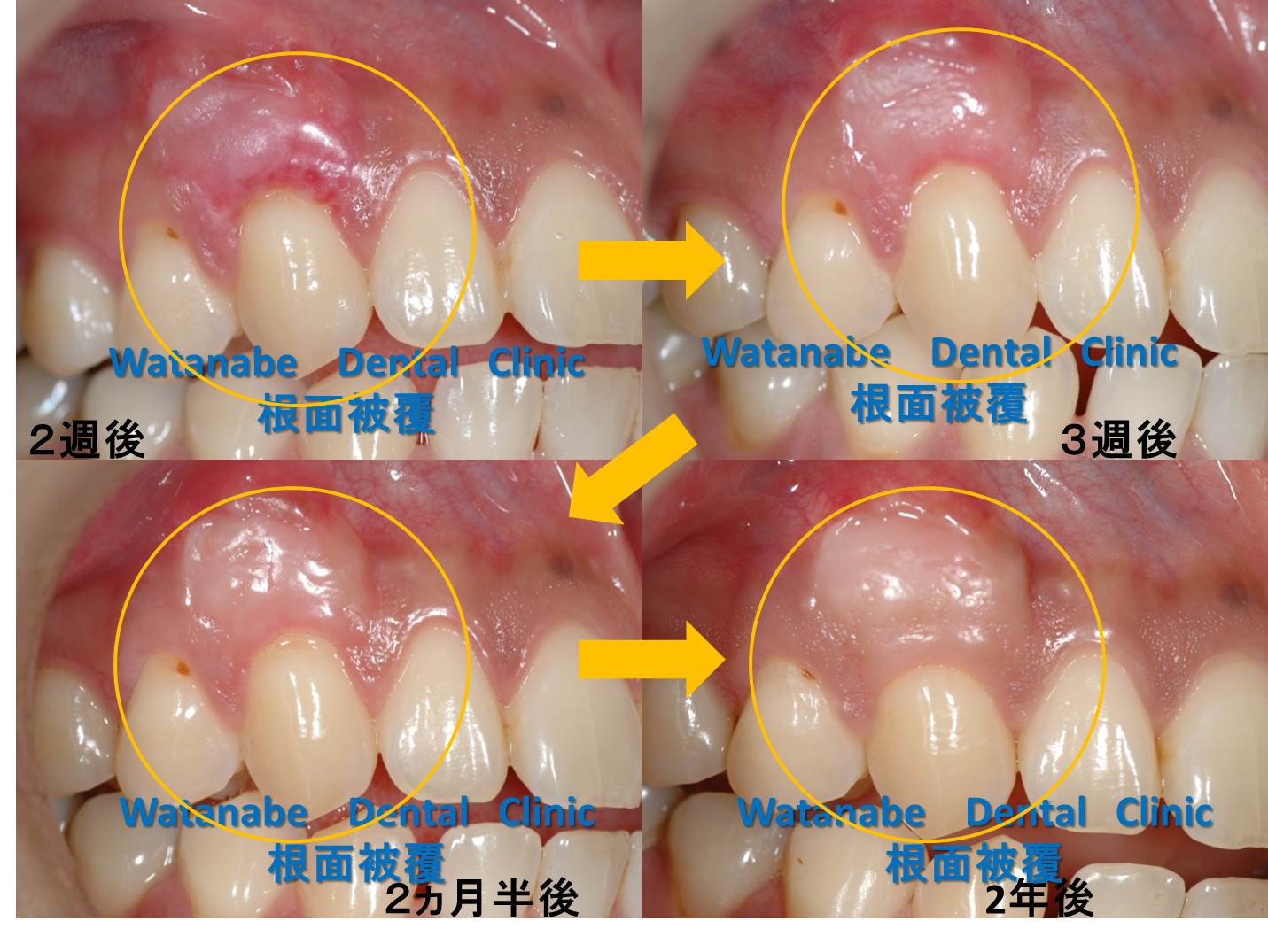 結合組織移植術予後2
