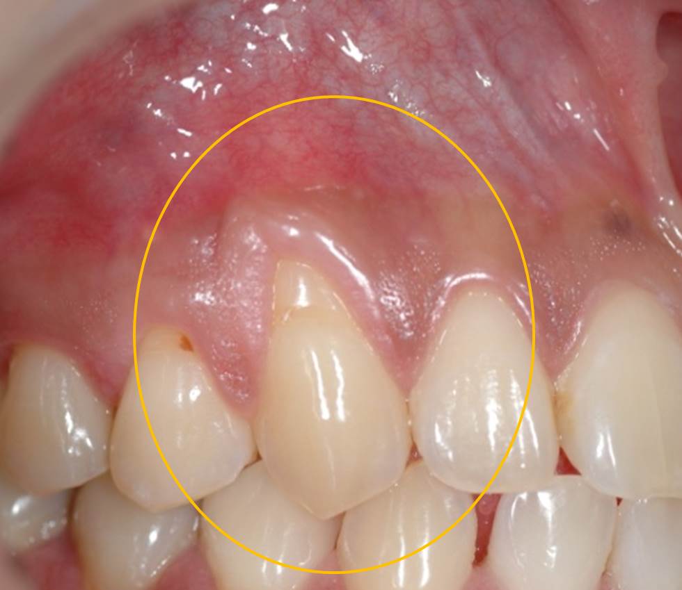 結合組織移植術術前2