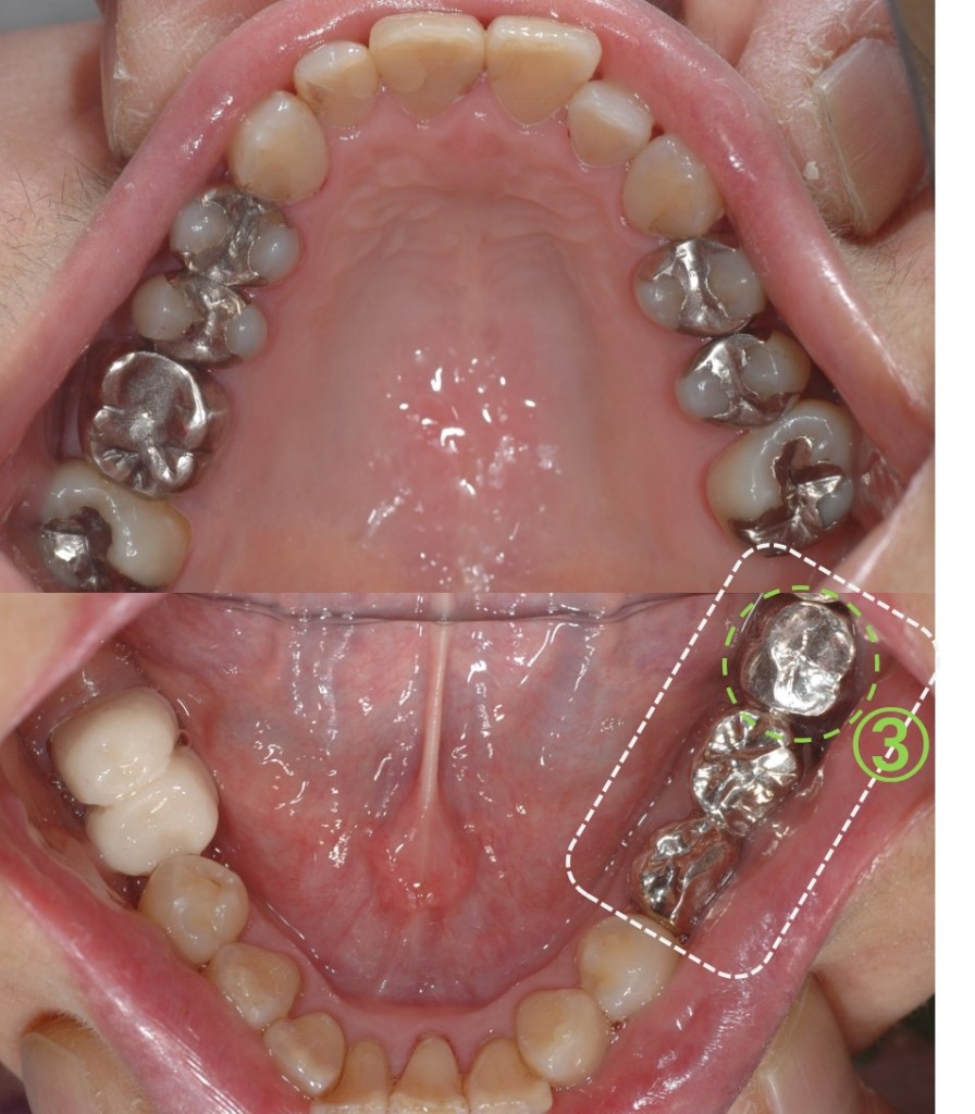 歯の移植（歯周病）６