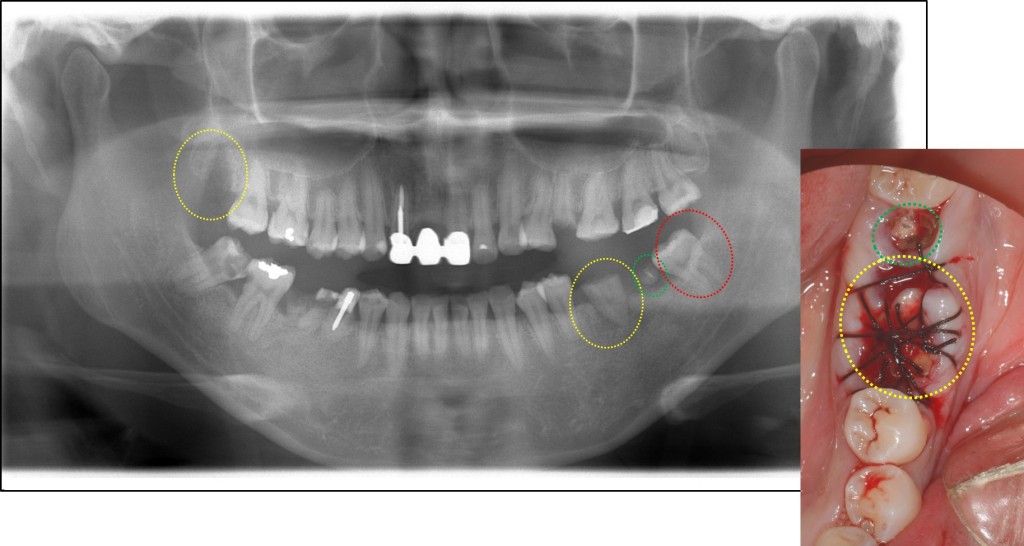 親知らずの移植２　歯周病専門医　渡辺歯科医院（小矢部市砺波地区）