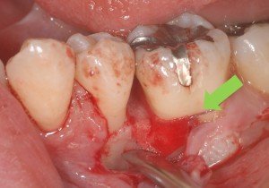 歯周病　GTR法