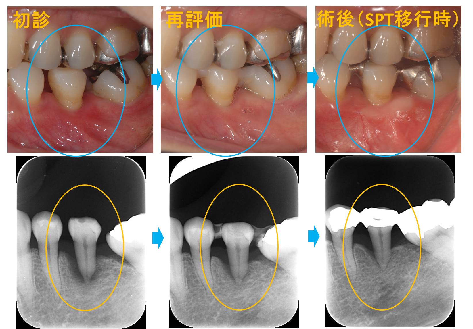 重度歯周炎（初診→再評価→SPT）