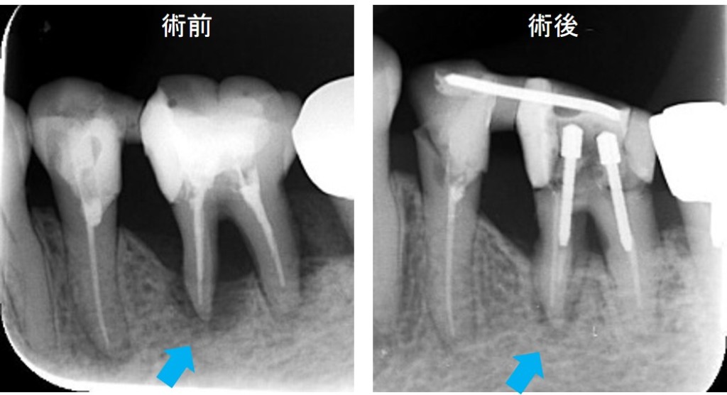 歯周病治療（SRP）