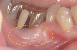 遊離歯肉移植術予後
