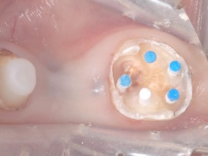 ファイバーコア　歯周病専門医