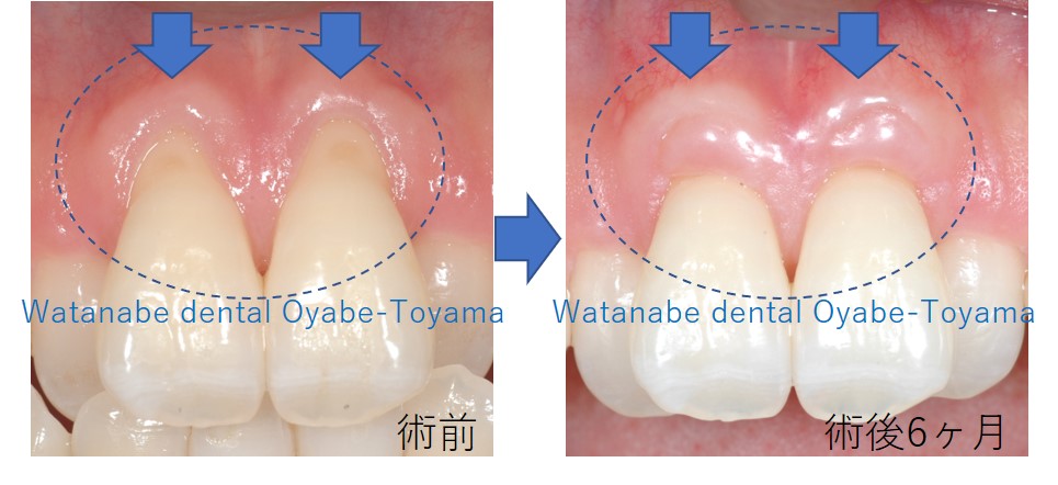 痩せる 歯茎 抜歯後に骨を再生させる方法とそれにかかる期間