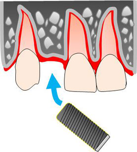 �t�B�N�N�`���[������p