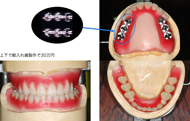 S-Aブレード臼歯